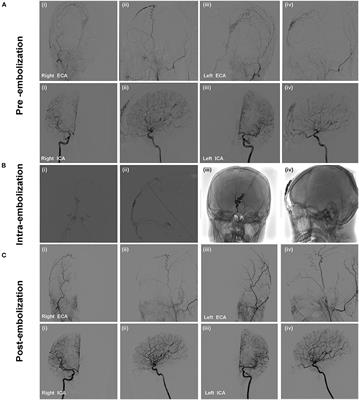 Case report: Endovascular treatment of two scalp arteriovenous malformation cases via direct percutaneous catheterization: A case series